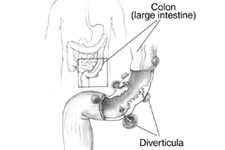 Diverticulum in the Colon