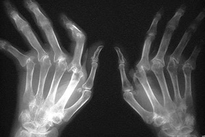 What Is Rheumatoid Arthritis?