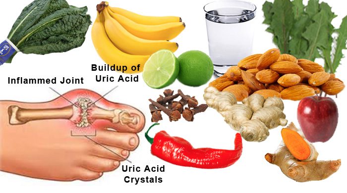 Natural Gout Treatment