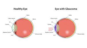 Foods That Help Treat Glaucoma