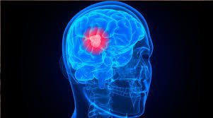 Combination Of CBD And THC Cannabinoids Inhibits Glioma Brain Cancer Growth