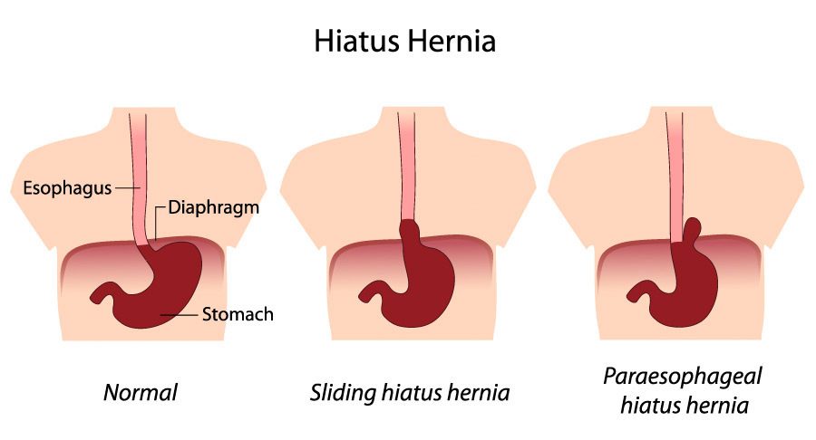 Lack Of Fiber, Hiatal Hernia, And Increased Acid Reflux