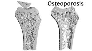 Consuming Phytates Helps Strengthen Bones And Reduces Osteoporosis Risk