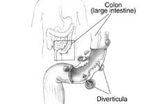 Symptoms of Diverticulitis