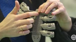 Cancer Patient Fitted With Titanium 3D Printed Ribs