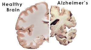 Atherosclerosis Of The Brain And Its Role Alzheimer’s Disease