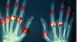 A Plant Based Diet Is Protective Against Rheumatoid Arthritis