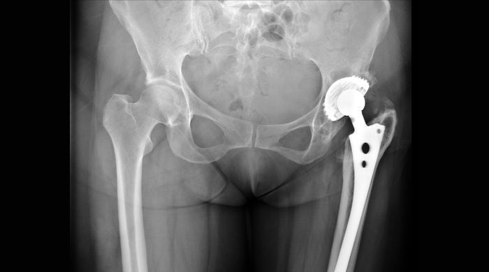 A Reason Why Milk Consumption Makes Weaker Bones - Galactose