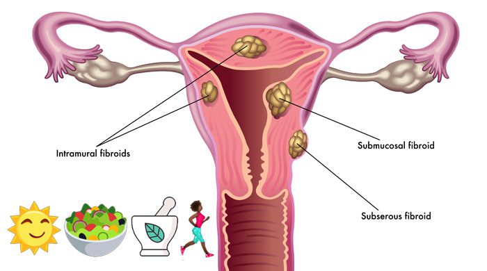 Shrink Fibroid Tumors Naturally