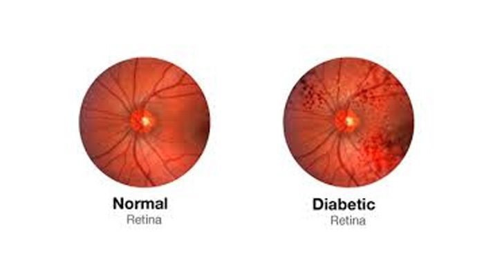 A Whole Food Plant-Based Diet Can Help Diabetic Retinopathy