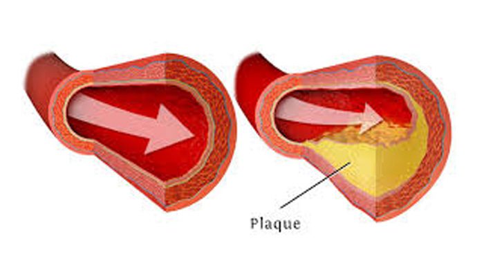 Vegan's Arteries Are The Best - If They Have Adequate Vitamin B12 Levels